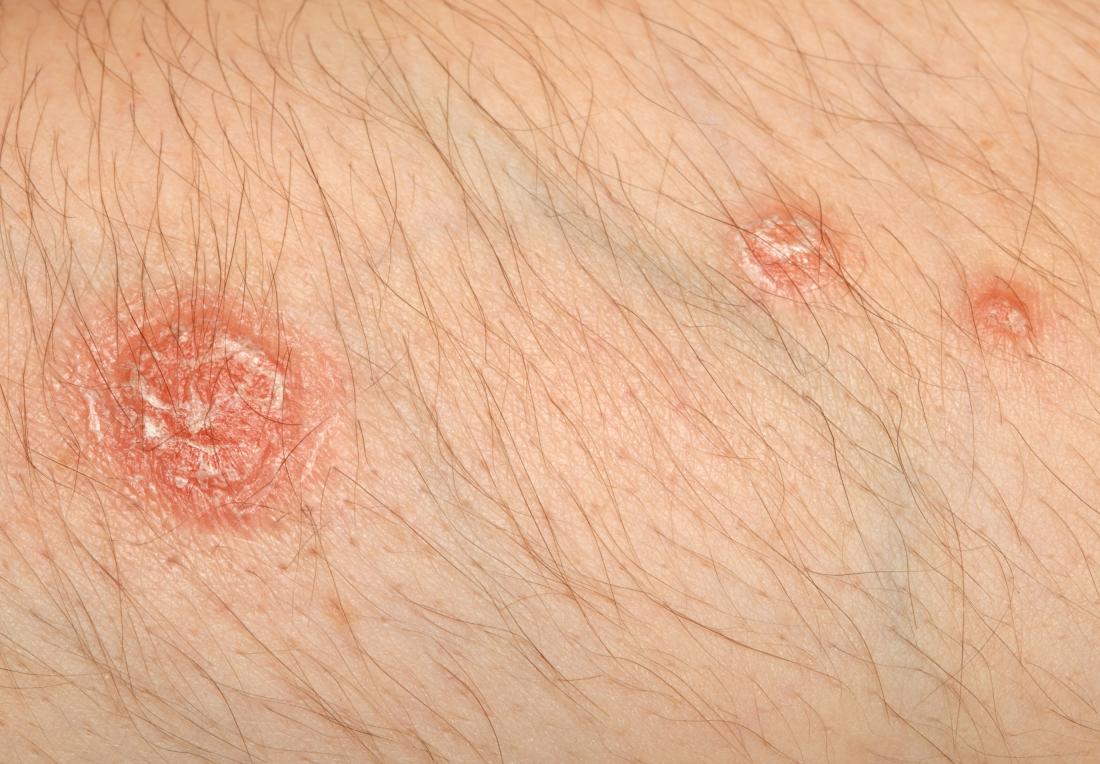 Psoriasis patches on skin.