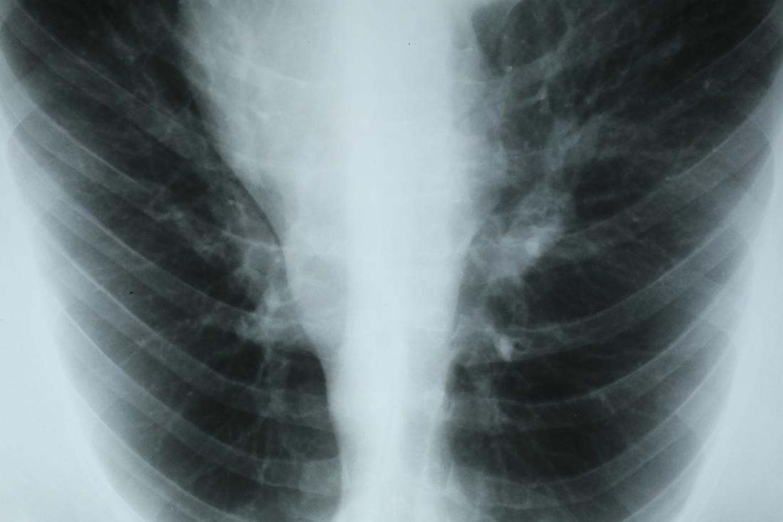 X-ray of chest focusing on ribcage and lungs