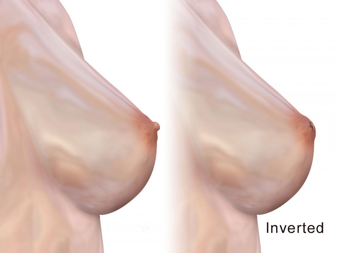Inverted nipple diagram <br>Image credit: BruceBlaus, 2016</br>