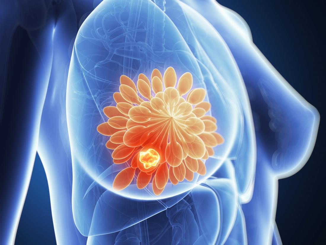 breast cancer tumor illustration