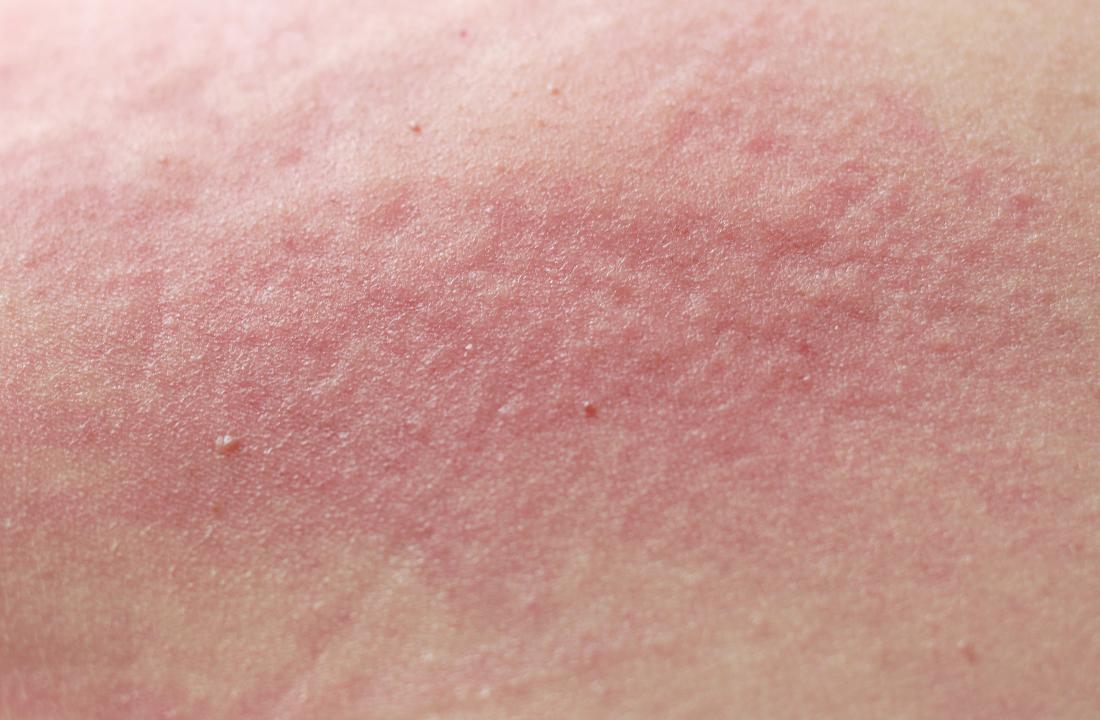 Redness rash on skin
