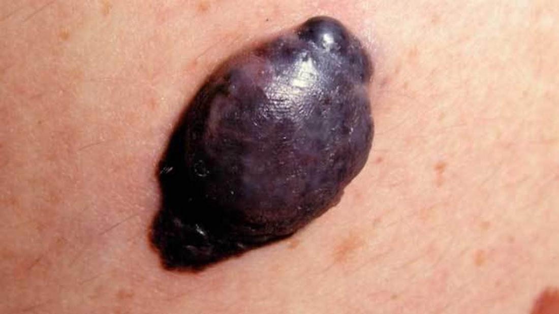 nodular melanoma <br>Image credit: Dermnet New Zealand</br>