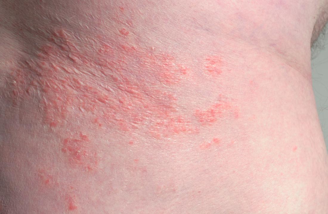 Psoriasis on skin fold