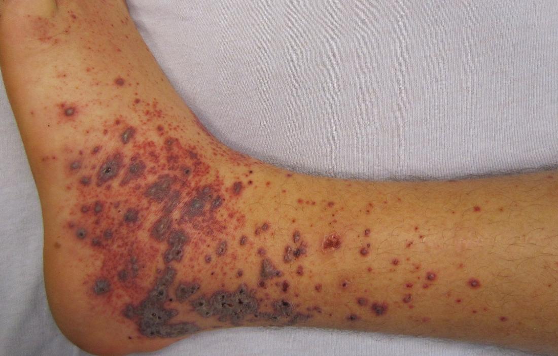 petechia and purpura also known as anemia rash br image credit james heilman md 2010 october 23 br