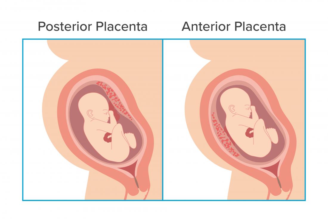 Anterior placenta illustration.