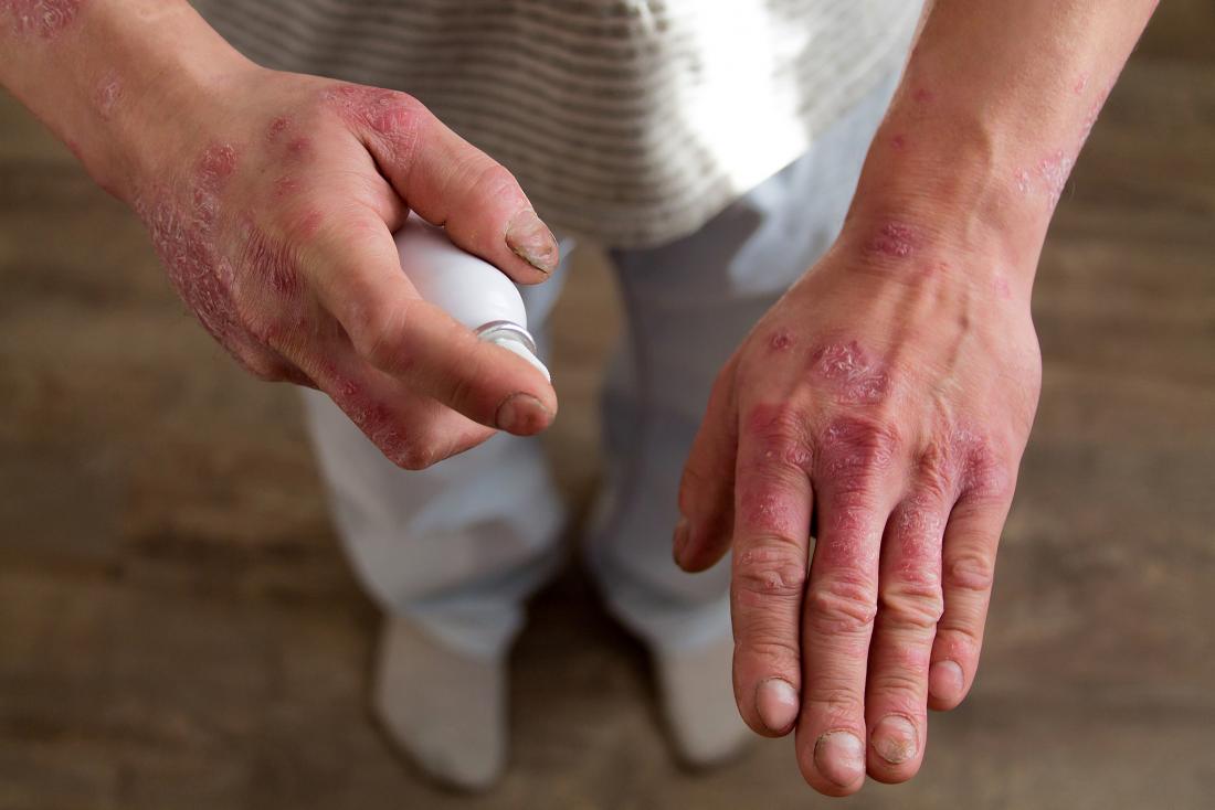 person with psoriasis on their hands