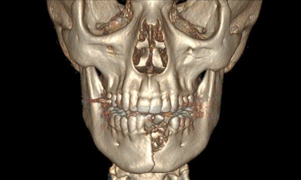 A reconstructed computed tomography showing the injuries suffered by a teenager when an e-cigarette exploded in his mouth.