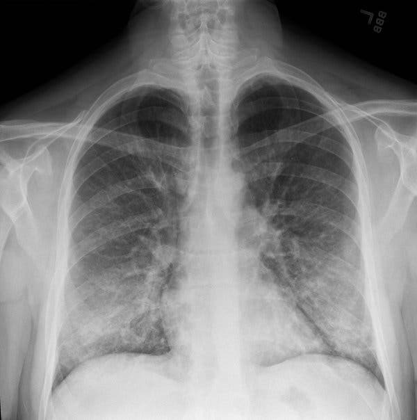 An X-ray of a patient with a vaping habit shows whitish, cloud-like areas typically associated with some pneumonias, fluid in the lungs or inflammation.