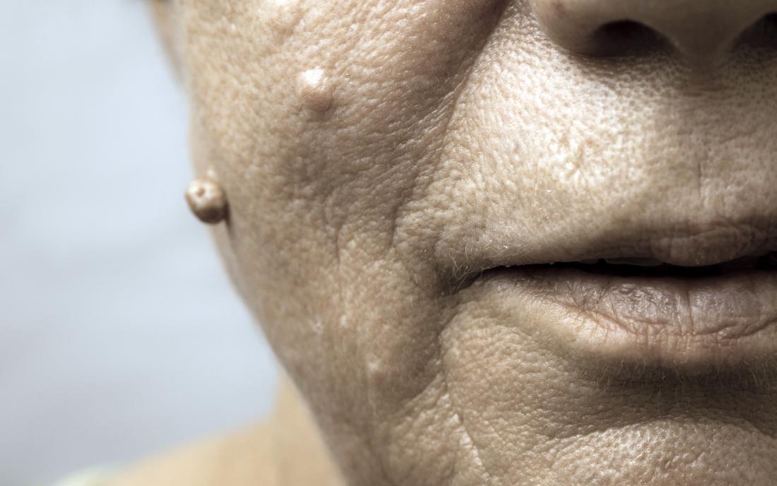 a close up of the warts on a womans face. 