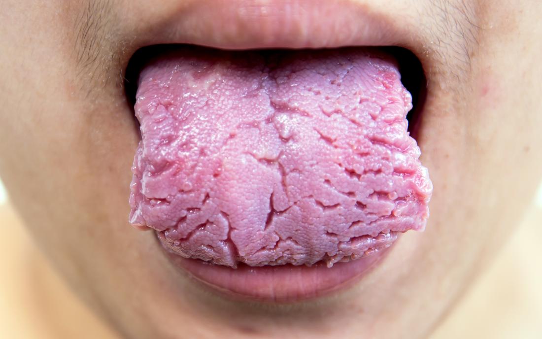 a fissured tongue