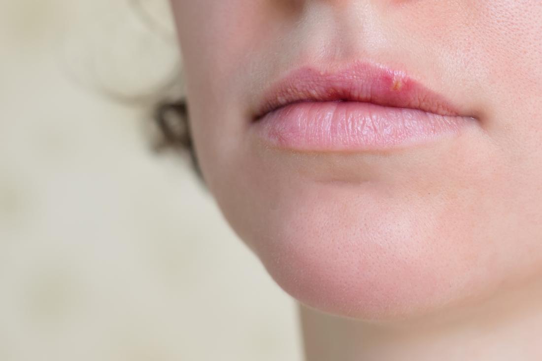 Woman with herpes on lip