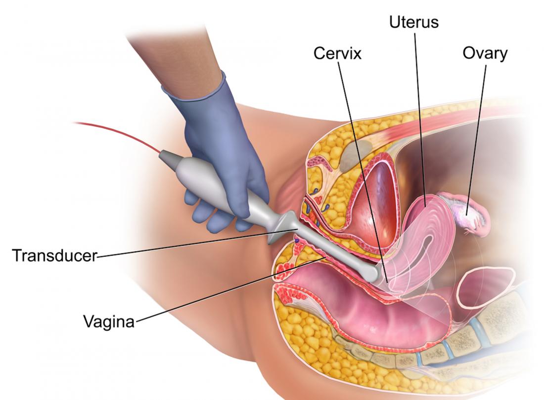 Diagram of Transvaginal ultrasound <br>Image credit: BruceBlaus, 2015</br>