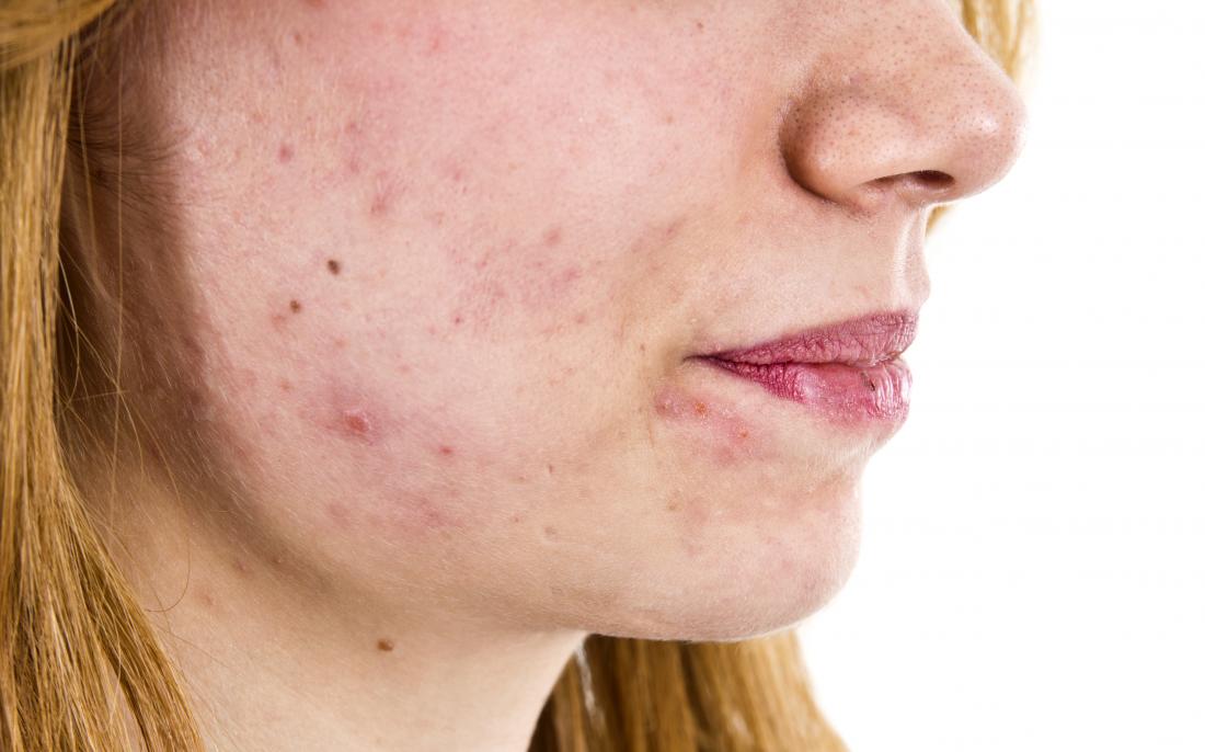 acne on a woman s face which may indicate high testosterone in women