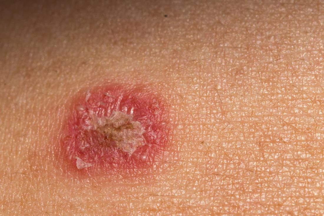 Ringworm on the skin