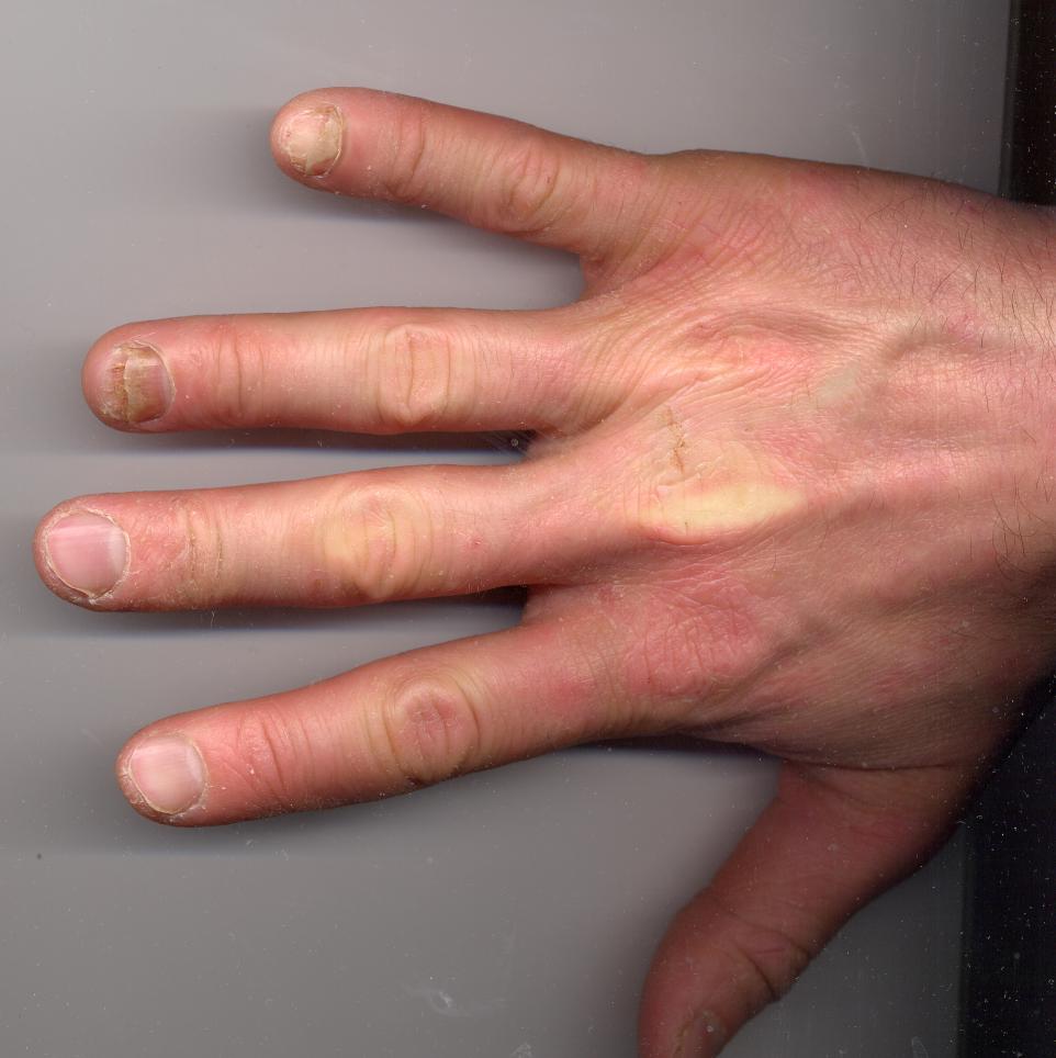 psoriatic arthritis nails onycholysis