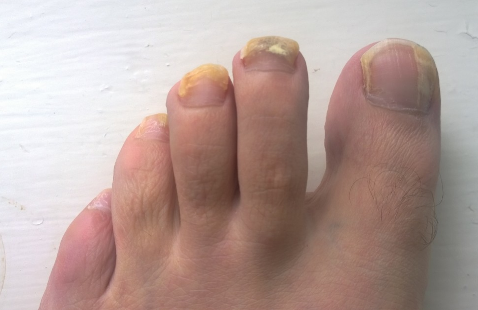 psoriatic arthritis nails fungal infection