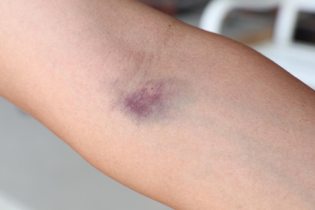 Alcohol and humira injection bruise