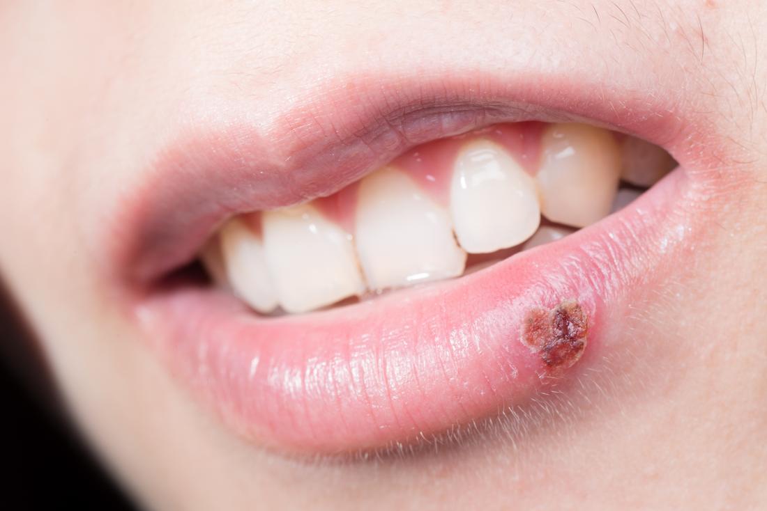 close up of lip with scabbed over cold sore