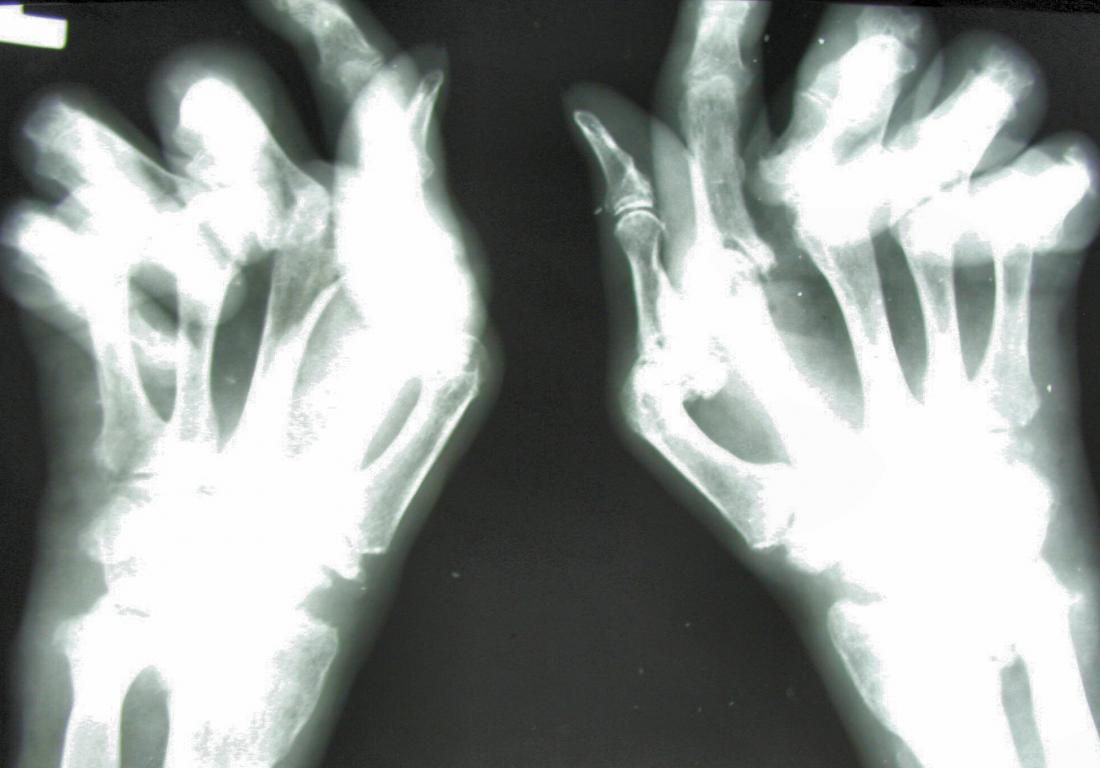 xray of hands with rheumatoid arthritis Image credit: Jojo, 2005