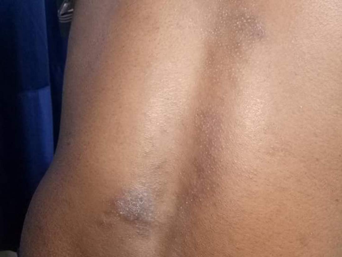 Eczema on a mans back <br>Image credit: Mohammad2018, 2018</br>
