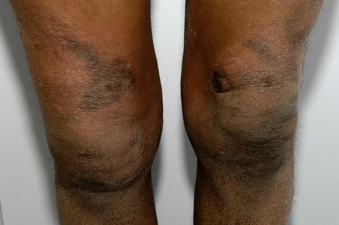 Eczema on the knees