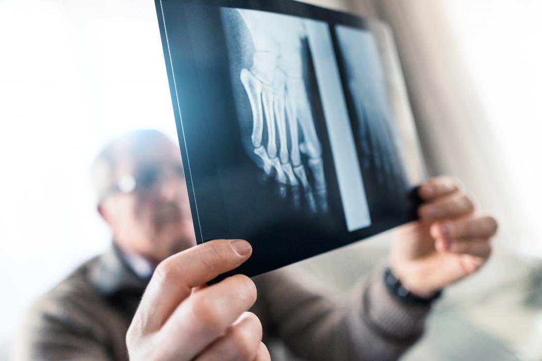 A doctor may request an x-ray to help diagnose the cause of pain at the big toe joint.
