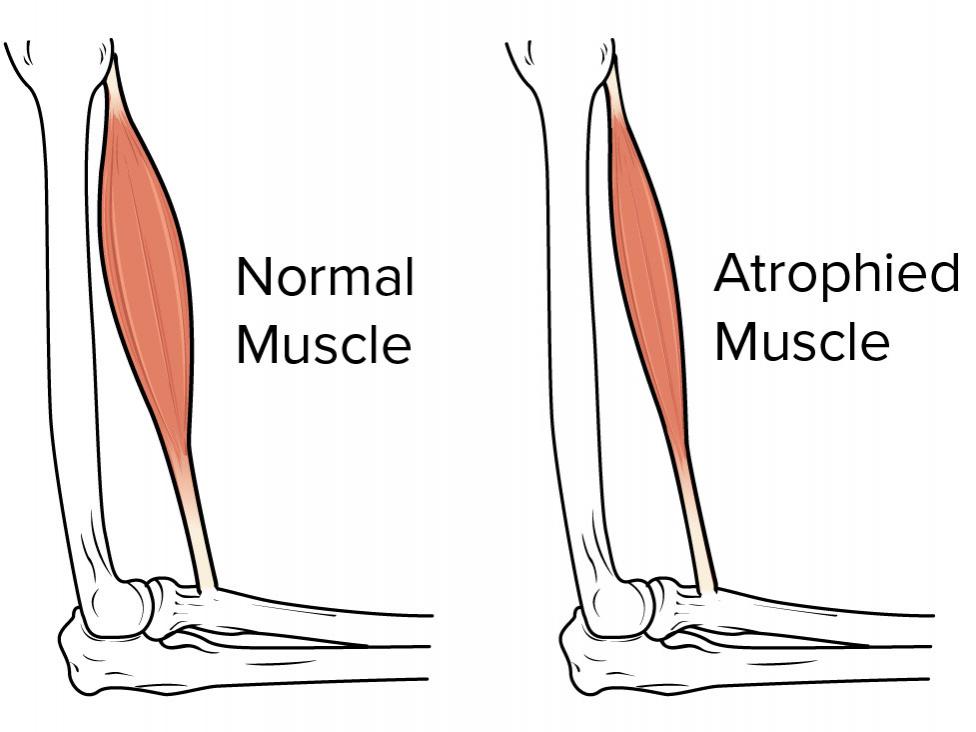 Illustration of muscle atrophy. Image credit: OpenStax, 2016.