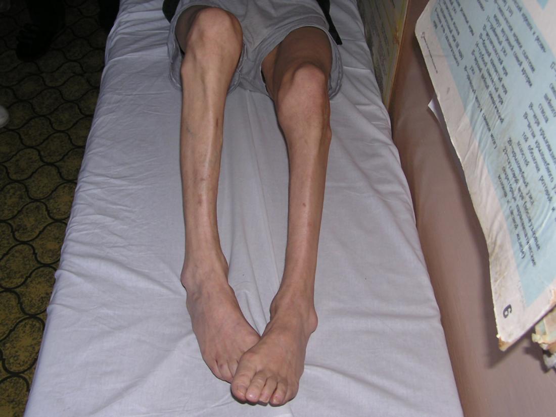Muscle atrophy in person's legs