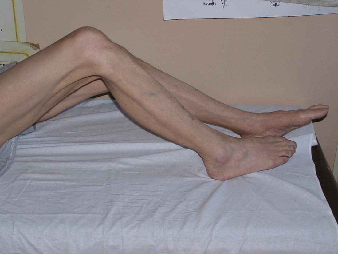 Muscle atrophy and wasting in legs.