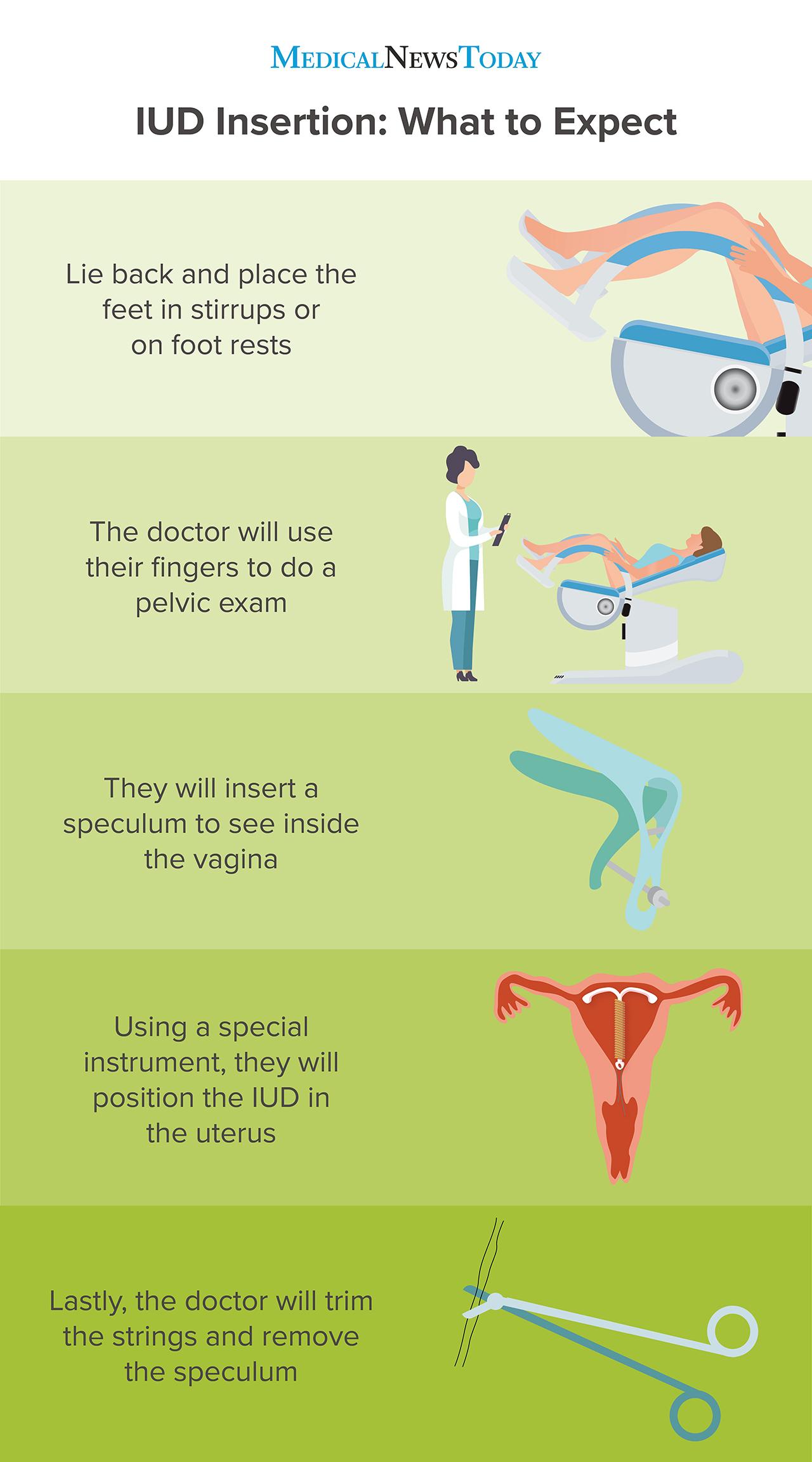 IUD insertion - what to expect infographic <br>Image credit: Stephen Kelly, 2019</br>