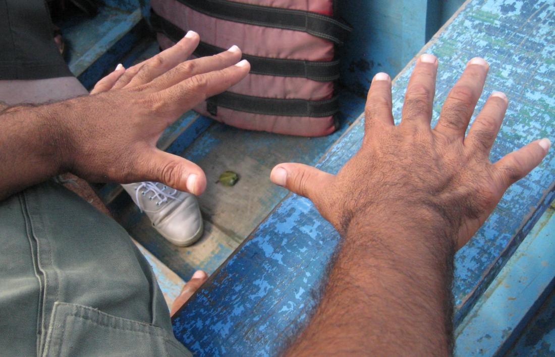 central polydactyly causing person to have six fingers image credit wilhelmy 2014 march 2