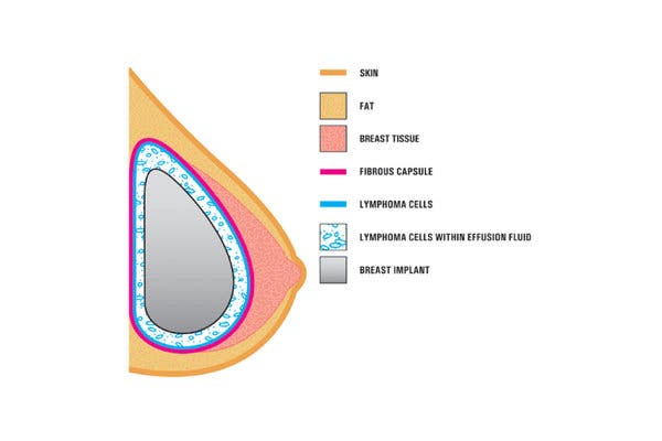A diagram from the F.D.A. showing how the cancer forms around the implant. The lymphoma is usually found near the breast implant, contained within the fibrous scar capsule or in the fluid surrounding the implant. The disease is not in the breast tissue itself. Researchers have not been able to explain the link between the textured implants and the rare cancer.