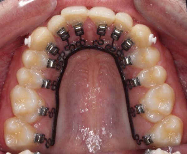 Technology by Mechanodontics, a start-up, straightens teeth from behind.