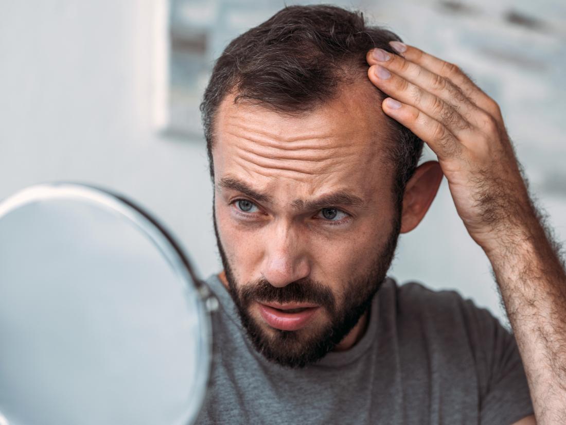 A man experiencing hair loss because of a problem with his Thyroid